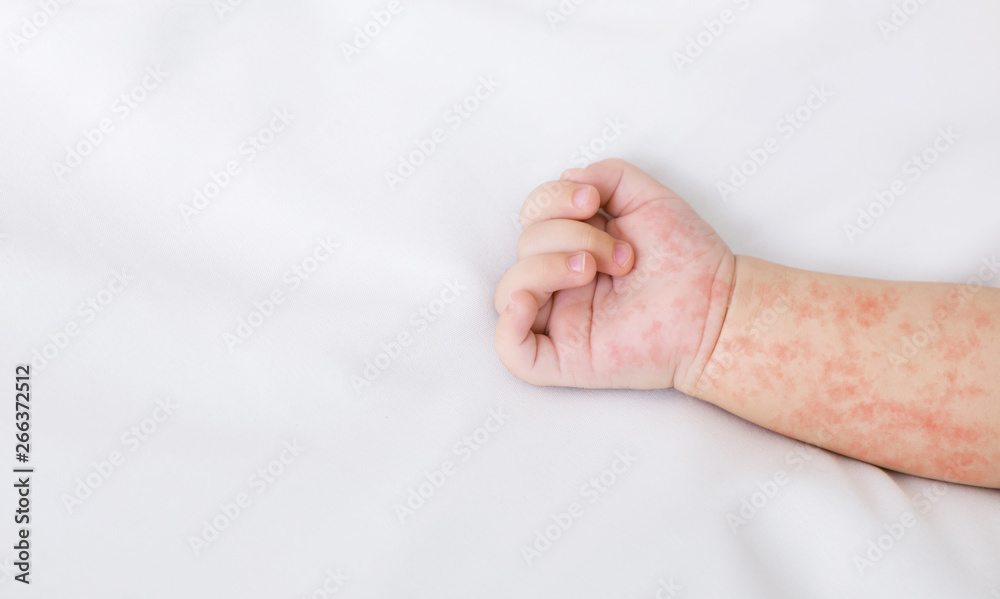 Hand of newborn baby with measles rash on white sheet - obrazy, fototapety, plakaty 