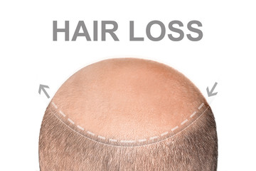 Concept of hair loss. Back view of balding male head isolated on white background. Detail showed alopecia