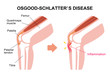 Osgood-schlatter disease (knee joint disease) illustration