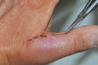 Ziehen des Fadens nach einer Handoperation aufgrund eines Abrisses des ulnaren Seitenbandes am linken Daumen (Skidaumen) 
