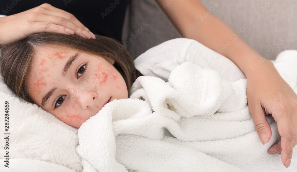 Girl With Measles Virus Lying On Mother Knees - obrazy, fototapety, plakaty 