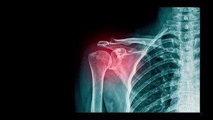 Wall Mural - footage of x-ray shoulder pain or frozen shoulder