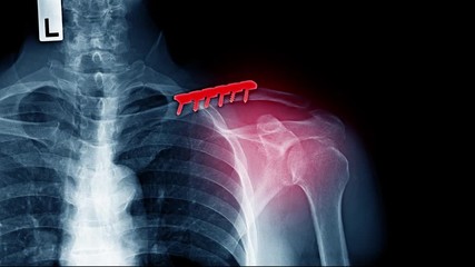 Poster - x-ray footage pacemaker cell, electrically charged medical device for abnormal heartbeat