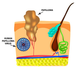 Human Papilloma Virus causes the formation of papillomas on the skin. Structure. Infographics. Vector illustration on isolated background.