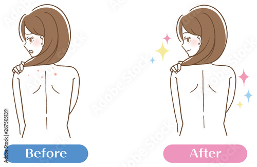 背中 ニキビ跡 毛穴汚れ 女性 ビフォーアフター Buy This Stock Vector And Explore Similar Vectors At Adobe Stock Adobe Stock
