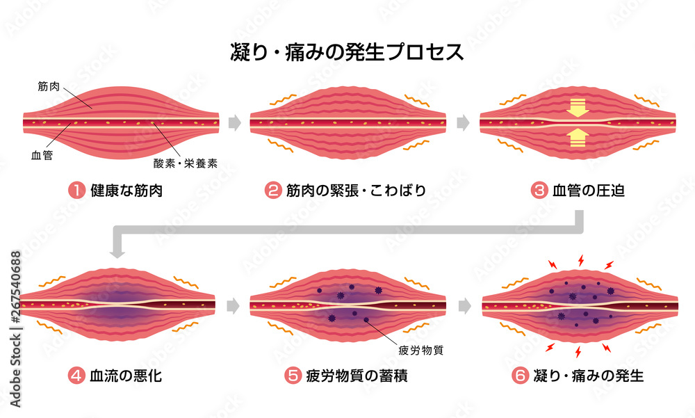 肩こり 凝り 痛みの発生プロセス 6ステップ イラスト Architecture Wall Mural Architectu Barks 肩こり 凝り 痛みの発生プロセス 6ステップ イラスト Architecture Wall Mural Architectu Barks