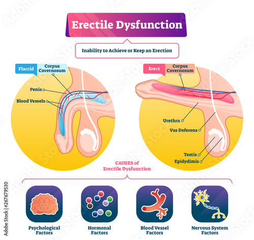 Fotografía Erectile dysfunction vector illustration