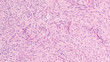 Microscopic image of a gastrointestinal stromal tumor (GIST).  Malignant potential depends on size, location and mitotic activity.  Targeted therapy with Imatinib (Gleevec) may prevent recurrence. 