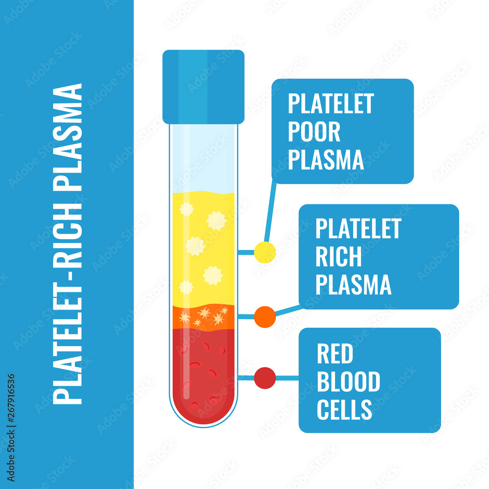 Blood after separation of platelets in the centrifuge. PRP infographics  with a test tube. Platelet-rich plasma laboratory equipment. Regenerative  medicine concept. Vector illustration. Stock Vector | Adobe Stock, image size:1000x1000