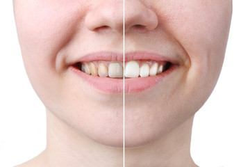 whitening or bleaching treatment ,before and after ,woman teeth and smile, close up, isolated on white