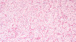Microscopic image of an adrenal cortical adenoma, a benign tumor of the adrenal gland, which may produce hormones cortisol or aldosterone and lead to Cushing's syndrome or primary hyperaldosteronism.