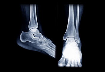 Poster - x-ray ankle or radiographic image or x-ray image of right ankle joint ap and lateral view for diagno