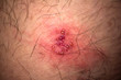 © pinglabel - skin rash and blisters on body (Shingles on men herpes zoster)