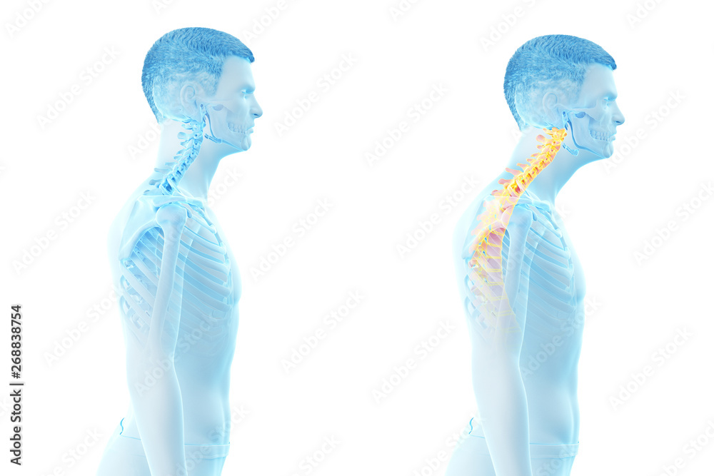 3d rendered medically accurate illustration of a man with a forward head posture - obrazy, fototapety, plakaty 