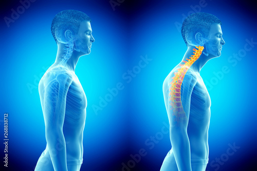 Fotografía 3d rendered medically accurate illustration of a man with a forward head posture