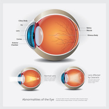 Eye Anatomy With Eye Abnormalities Vector Illustration