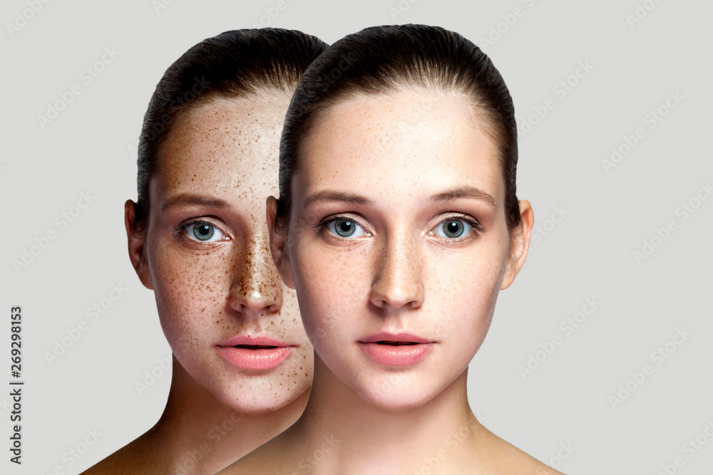 Closeup before and after portrait of beautiful brunette woman after laser treatment removing freckles on face looking at camera. makeup or cosmetology. indoor studio shot, isolated on gray background. - obrazy, fototapety, plakaty 
