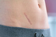 Scar on the abdomen after removal of appendicitis and abdominal surgery. Body scars close up
