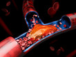 3d Illustration of Deep Vein Thrombosis or Blood Clots. Embolism