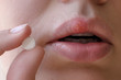 © domaskina - Part of a young woman's face with a virus herpes simplex on lips, treatment with pills