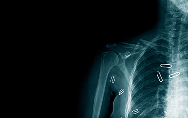 Poster - x-ray image clavicle fracture