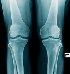 Canvas Print - x-ray image OA knee both side