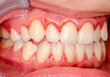 teeth with gingivitis