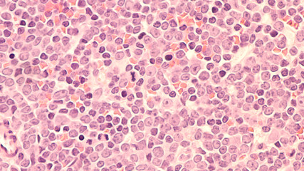 A staging bone marrow biopsy shows replacement of normal elements by diffuse large B-cell lymphoma, a type of non Hodgkin lymphoma, a malignancy (cancer) of lymphocytes, in this case spread to bone. 