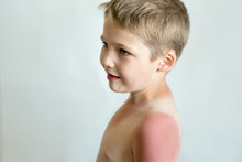 Strong Tan In The Boy. Red Hands And Back. Sore Skin, Blistered. No Sun Protection