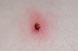 © Oksana - Tick with its head sticking in human skin