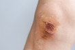 © lzf - Scar and scab (eschar) on asian female knee