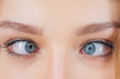 Strabismus Eye Surgery. Close up of crazy female eyes with squint. Eye muscle recession. Extraocular Muscle Anatomy.