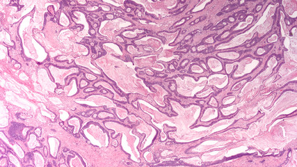 Wall Mural - Colon Cancer: Photomicrograph (microscopic image) of an invasive colonic adenocarcinoma. Screening colonoscopy (endoscopy) can detect precancerous polyps (adenomas) and prevent colon cancer.