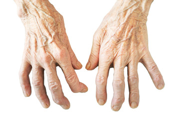 Rheumatoid polyarthritis of hands isolated on white background