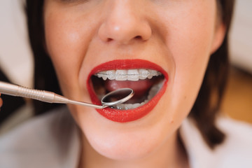 Attractive young woman with red lips and white teeth with braces at a dentist clinic. Beauty woman smile with orthodontic accessories. Orthodontics treatment. Closeup of healthy female mouth.