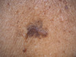 skin cancer or melanoma on collarbone type of superficial spreading be an existing spot, freckle or mole change color, size or shape caused by ultraviolet (UV) light damaging the DNA in skin cells.