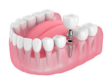 dental-implant-free-stock-photo-public-domain-pictures