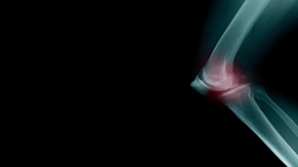 Poster - OA knee x-ray, hight quality footage OA knee x-ray in blue tone 