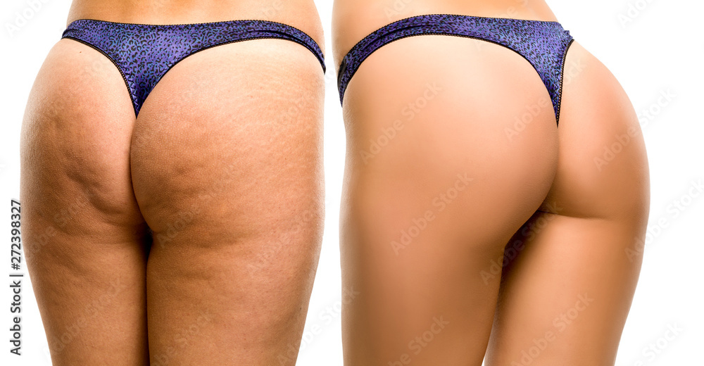 Female buttocks before and after on white background - obrazy, fototapety, plakaty 