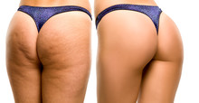 Female Buttocks Before And After On White Background