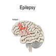 Human brain with hotspot hotspot of epilepsy