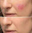 © Alessandro Grandini - Comparison between before and after a treatment for rosacea