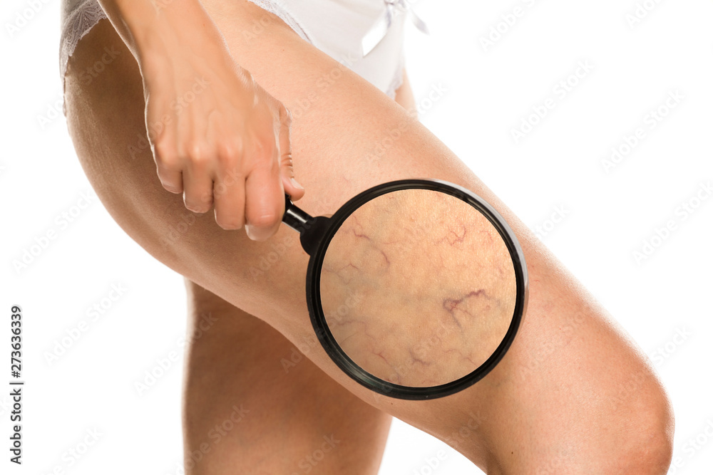 woman shows enlarged capillaries on her leg by magnifying glass on white background - obrazy, fototapety, plakaty 