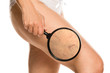 Leinwandbild Motiv woman shows enlarged capillaries on her leg by magnifying glass on white background