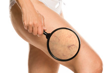 Woman Shows Enlarged Capillaries On Her Leg By Magnifying Glass On White Background