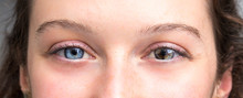 Human Heterochromia Iridium, Woman Eyes Showing Difference In Coloration