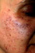 © timonina - Pigmented spots on the face. Pigmentation on cheeks