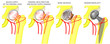 Vector illustration of femoral head blood supply, femoral neck fracture and blood vessels problem, femoral head necrosis and hemiarthroplasty of the hip. For advertising and medical publications.