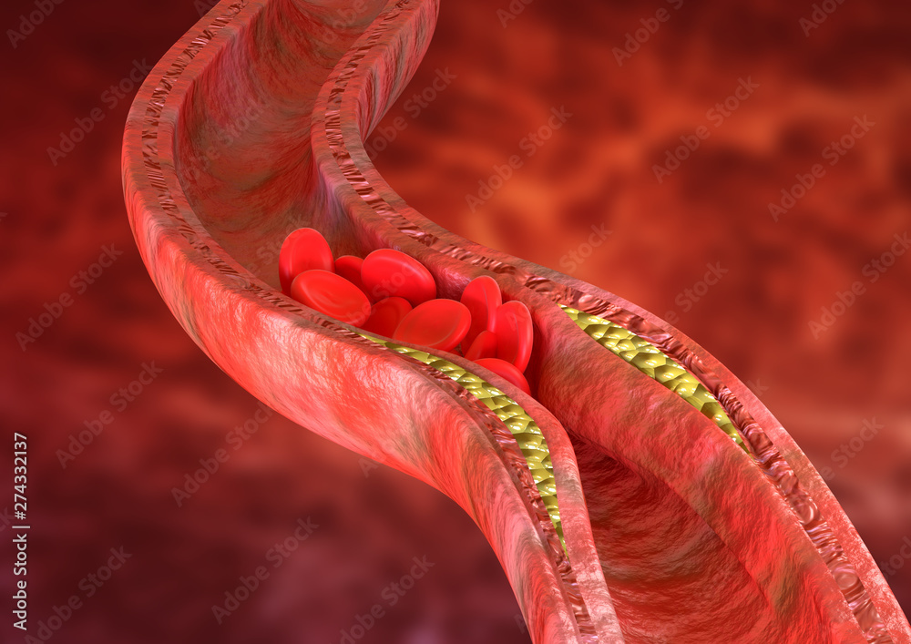 Atherosclerosis is an accumulation of cholesterol plaques in the walls ...