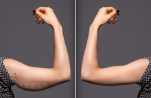 Woman Arms With Bat Wings, Comparison Between Before And After Brachioplasty Surgery